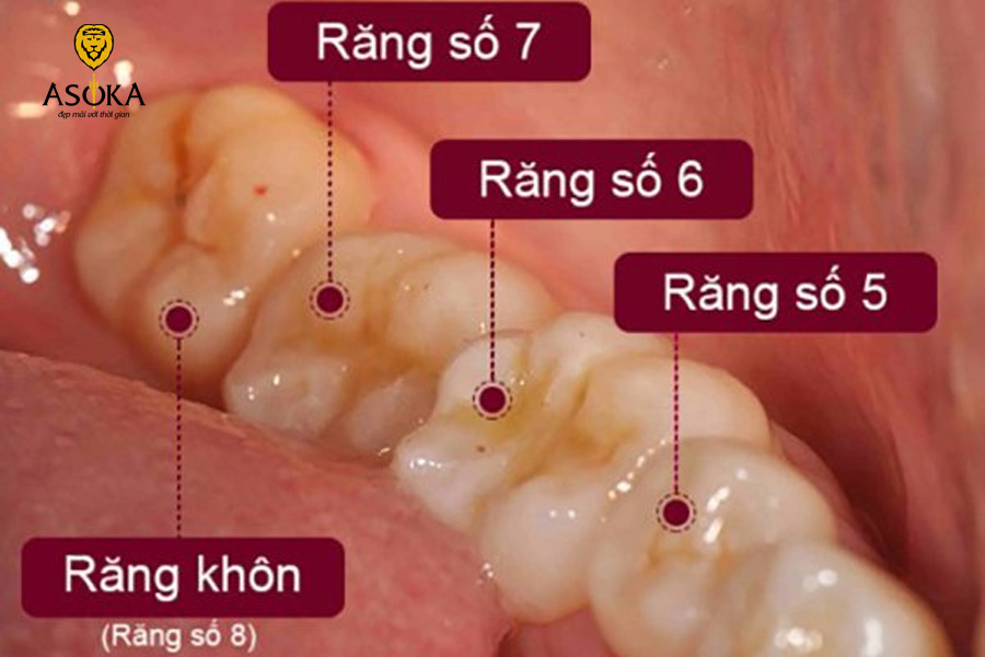 Răng khôn ảnh hưởng đến răng số 7 không