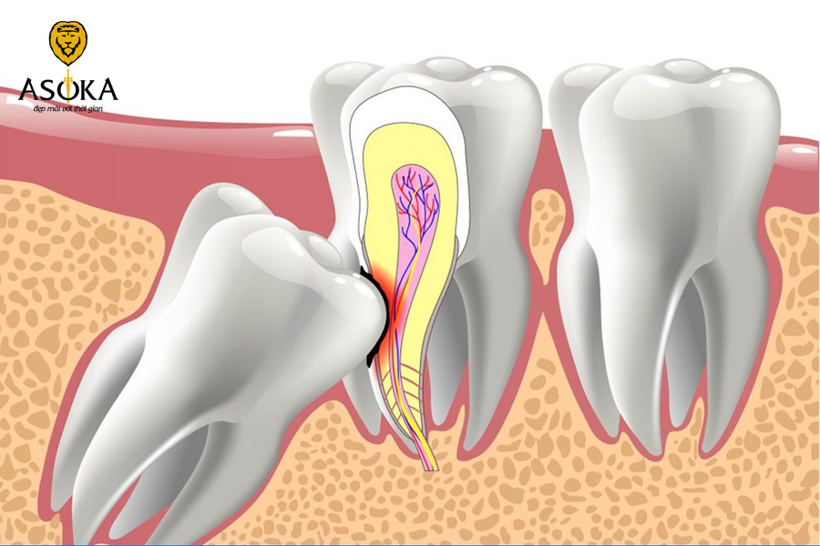 Nhổ răng khôn hàm trên có phức tạp không?