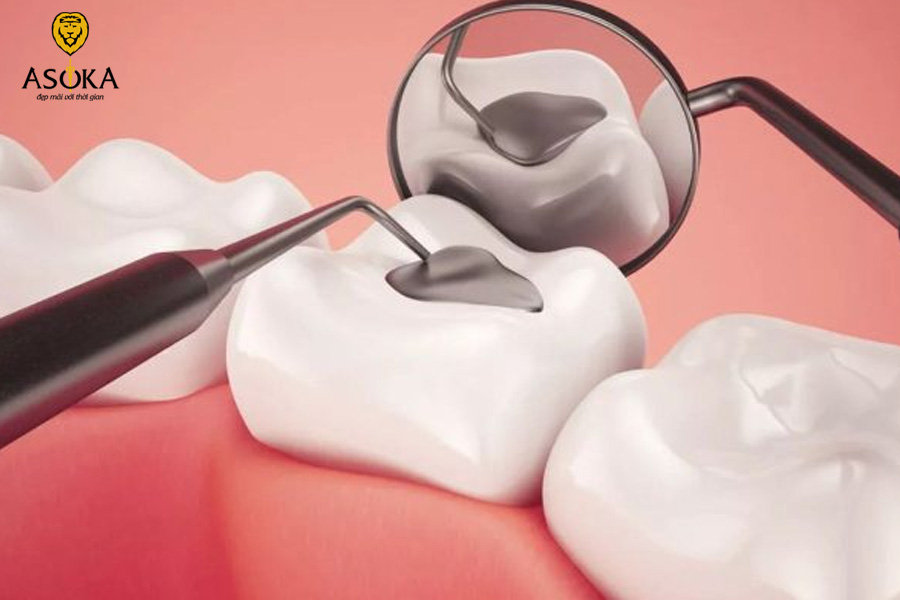 Quy trình trám răng tại nha khoa 