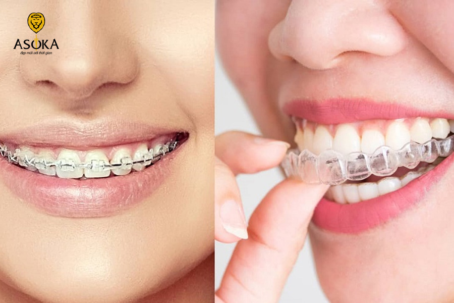 So sánh 2 phương pháp niềng răng